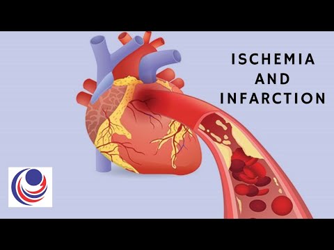 The difference and Similarities: Ischemia and Infarction
