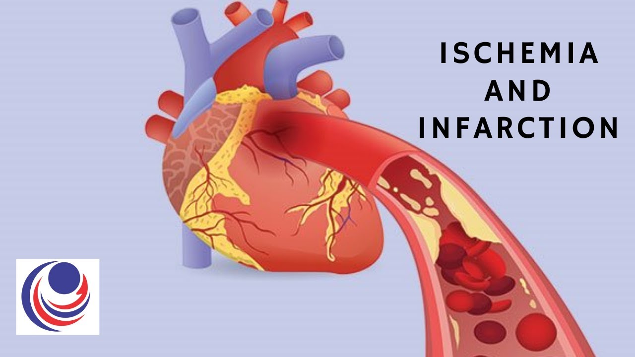 ischemia meaning