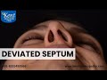 Deviated septum पथभ्रष्ट झिल्ली
