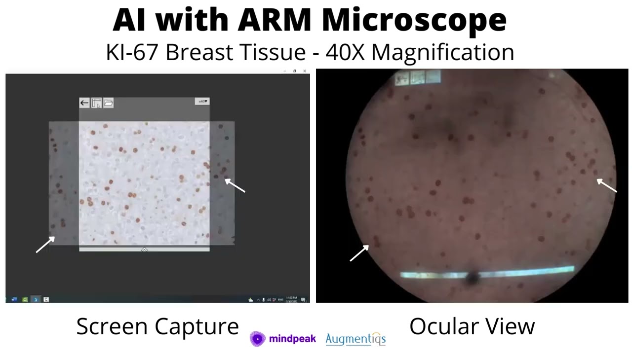 Augmented Reality Microscope with Mindpeak's Pathology Artificial Intelligence algorithms for Ki-67