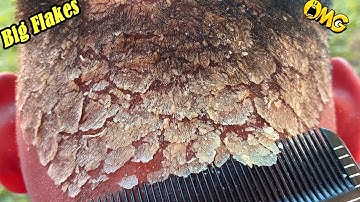 DRY SCALP !! Big Flakes Dandruff Scratching Satisfying Video #793