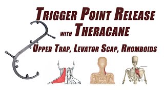 Trigger Point Release in the Upper Trapezius, Levator Scapulae, and Rhomboids Using a Cane Device