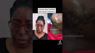 Doctor reacts to PCOS facial hair video