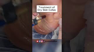 Say Goodbye to Dry Skin Callus | Callus Shaving by Famous Podiatrist Miss Foot Fixer