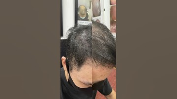 Tóc thưa nỗi khổ tâm cho bao người #xămtóc #hói_đầu #scalp xăm tóc #hói