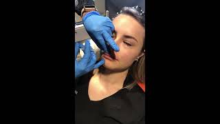 Botox Lip Flip Treatment