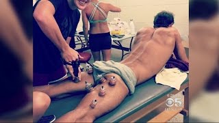 Bay Area Therapist Perfected 'Cupping' Therapy Used On Rio Athletes