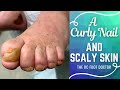 A Curly Nail and Scaly Skin