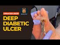 How to Cure Deep Diabetic Ulcers Fast