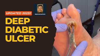 How to Cure Deep Diabetic Ulcers Fast screenshot 5