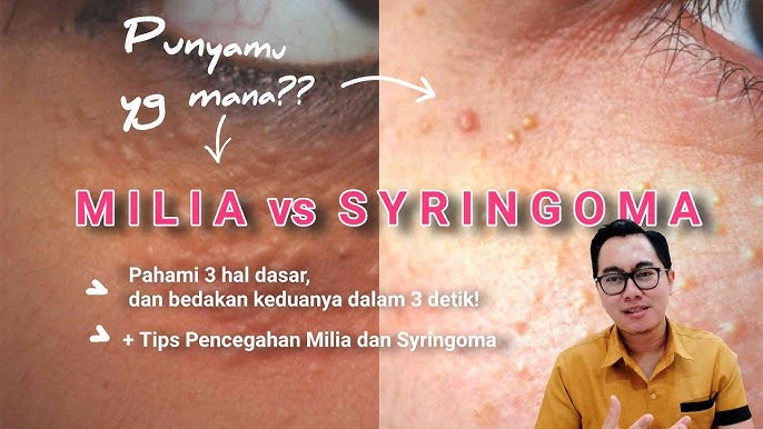 Harga Laser Co2 Natasha Skincare Simak Full Agar Tidak Gagal Paham Youtube