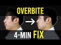 Overbite & Overjet Fix｜Facial Asymmetry Correction｜Corrective Exercises