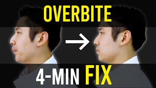 Overbite & Overjet Fix｜Facial Asymmetry Correction｜Corrective Exercises screenshot 3