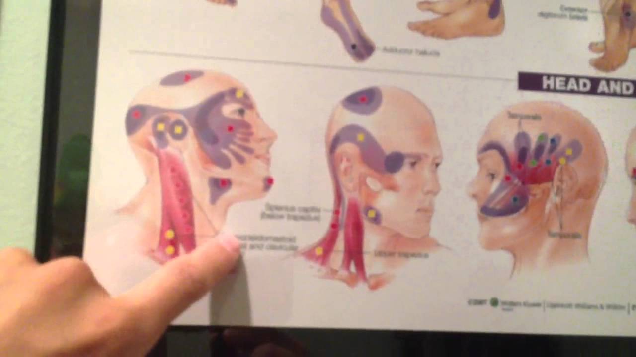 Where Do Headaches Come From? - YouTube