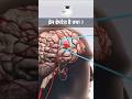 brain haemorrhage #brainhacks #breakingnews #astrology #news #doctor #brain #education #hospital