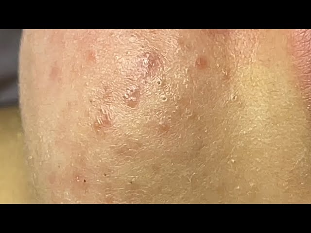 Relaxing acne treatment with Linh My Dang #322 P4 (Linh My Dang)