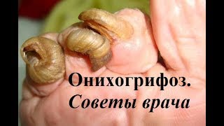 Онихогрифоз: советы врача