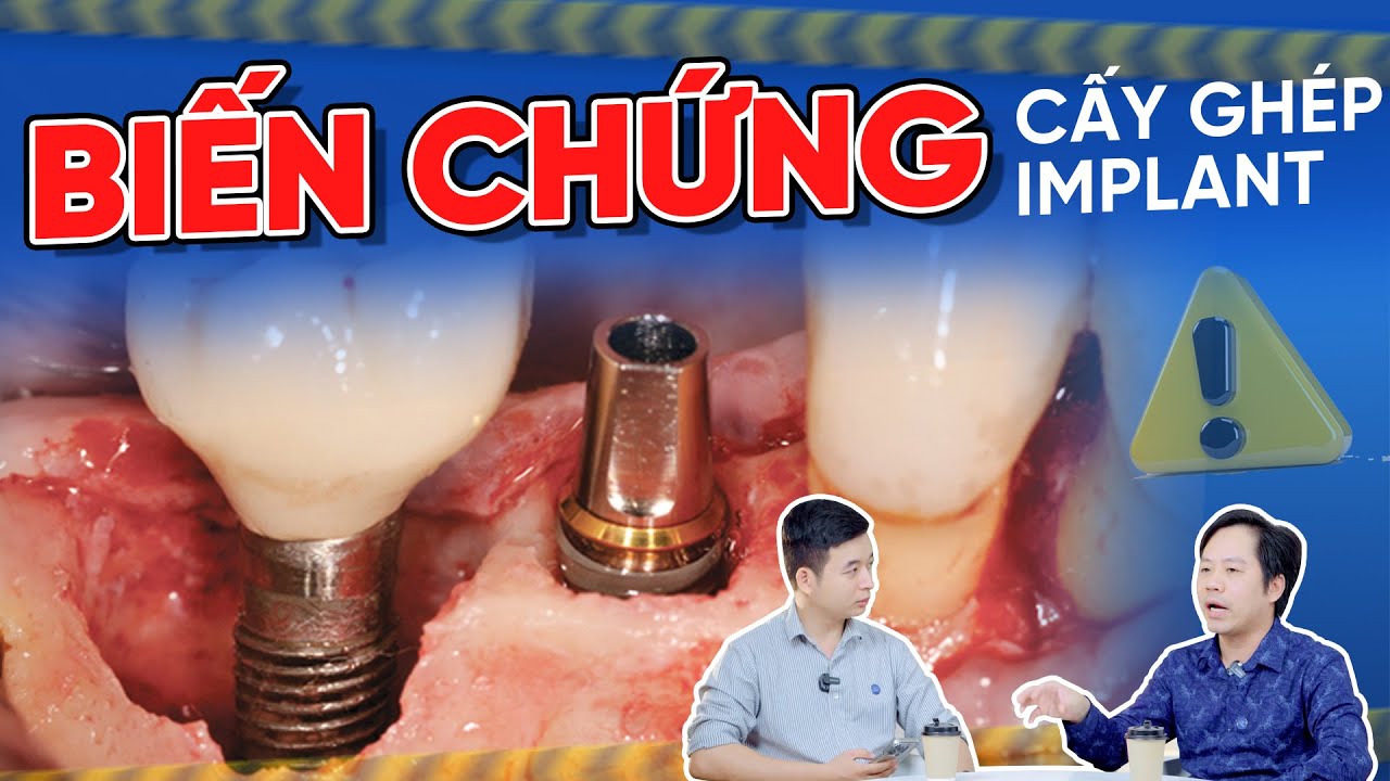 Outline Video 3 Biến Chứng RẤT NGUY HIỂM khi Cấy Ghép Implant - Dấu Hiệu Và Cách Xử Lý Tránh Rủi Ro