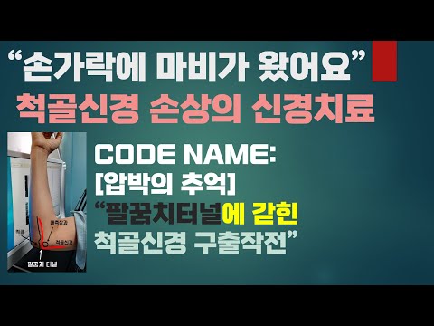 #42.손가락에 마비가 왔어요.[척골신경 손상의 신경치료; ulnar nerve injury]