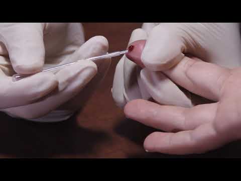 Videó: Hogyan szúrjunk ujjat vérfolt vizsgálathoz (képekkel)