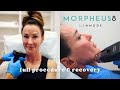 Morpheus 8  radiofrequency  microneedling treatment before  after full procedure  recovery