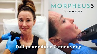 Morpheus 8  Radiofrequency + Microneedling Treatment Before & After! Full procedure & recovery