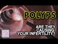 Uterine polyps: Removal for infertility?