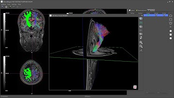 BrainMagix 2.1: Constrained Spherical Deconvolution (CSD)-based Tractography