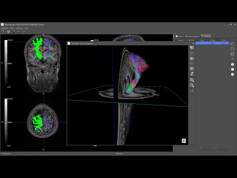 BrainMagix 2.1: Constrained Spherical Deconvolution (CSD)-based Tractography