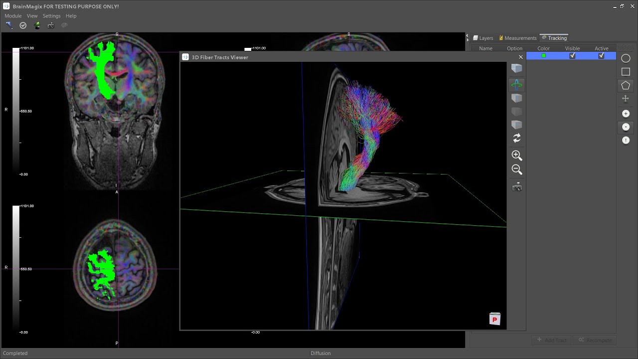 BrainMagix 2.1: Constrained Spherical Deconvolution (CSD)-based ...