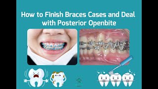 How to Deal with Posterior Openbite in Braces Cases