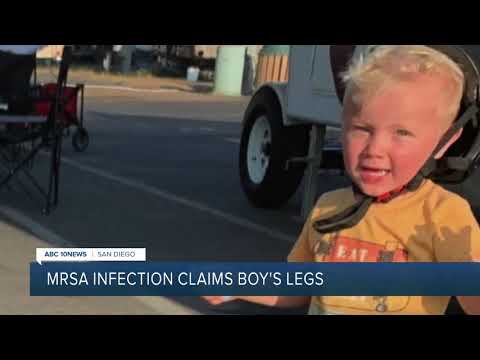 MRSA staph infection claims 3-year-old boy&rsquo;s legs during family vacation
