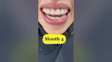 Invisalign Journey #shorts