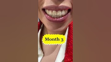 Invisalign Journey #shorts