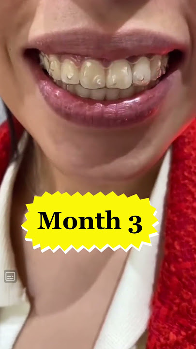 Invisalign Journey #shorts