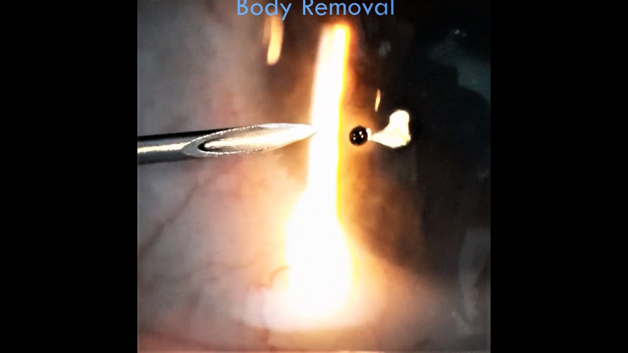 Metallic Corneal Foreign Body Removal with Needle Patient helps with