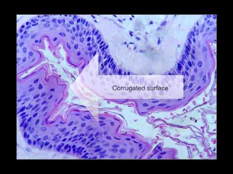 Odontogenic Keratocyst - YouTube