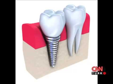 İmplantasyon Nedir?