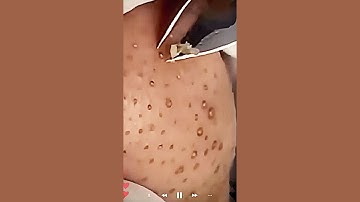 Skincare | Blackheads Removal #626 #tweezers skincare #blackheads blackheads