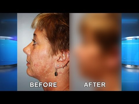 Extreme Acne Scar Procedure