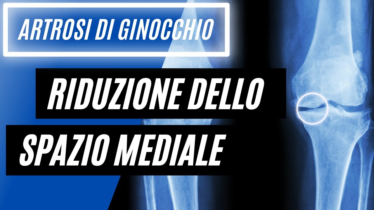 🔰 RIDUZIONE dello spazio (rima) femoro-tibiale ➤ ❗❗ ARTROSI DI GINOCCHIO ❗❗