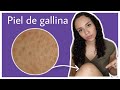 ¿CÓMO QUITAR LA PIEL DE GALLINA? / QUERATOSIS PILARIS
