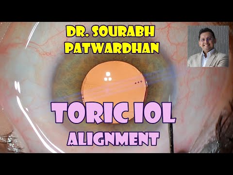 134 Toric IOL alignment Dr Sourabh Patwardhan