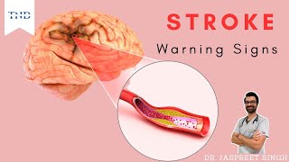 Early warning signs of stroke