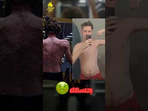 عمل تجربه ياخد هرمونات من اول يوم تمرين لغرض الشهره بوظ شكل جسمه