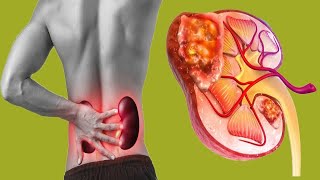 Can Kidney Stones Cause Kidney Cancer?