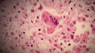 Answering most common questions about measles outbreak Answering Top Questions About Measles