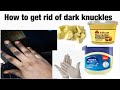 How to effectively get rid of dark knuckles naturally!