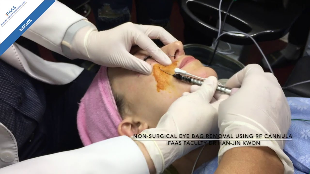 NonSurgical Eye bag Removal by Dr HanJin Kwon Part 1 Radio