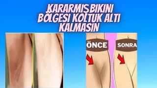 5 Dakikada Kararmış Bikini Bölgesi  Koltuk Altı  Ve Cilt  Ton Ton Nasıl Beyazlar ? - Güzellik Bakım